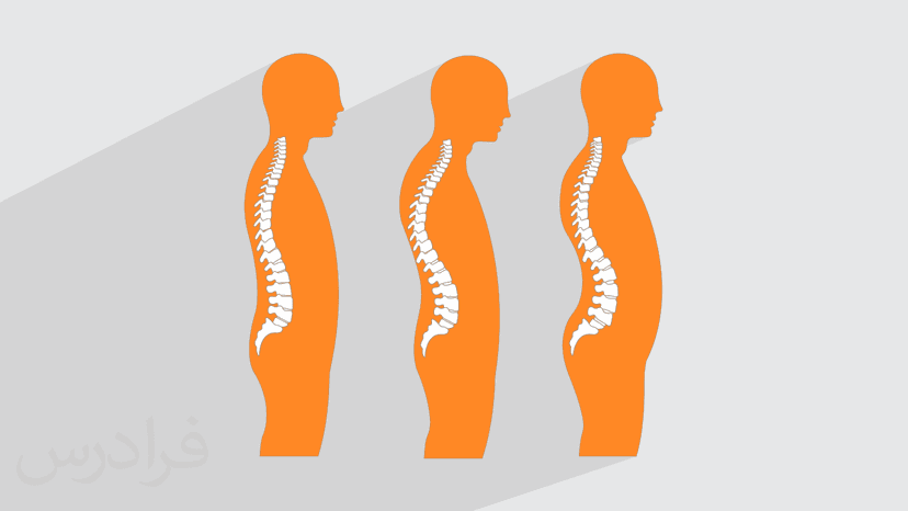 آموزش تشخیص ناهنجاری های قامتی – ستون فقرات و اندام فوقانی