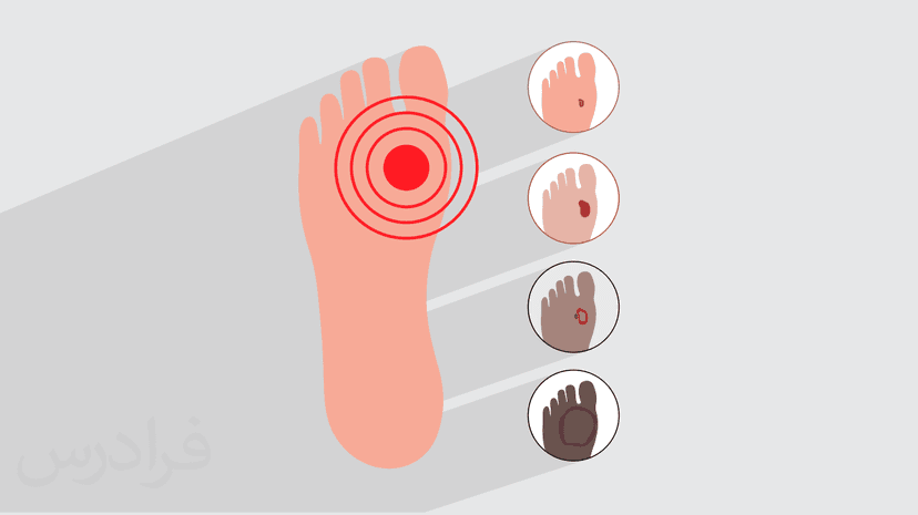 آموزش مراقبت از زخم پای دیابتی – پیش ثبت نام